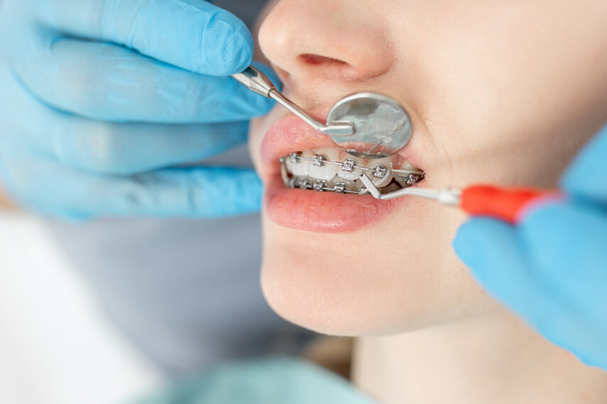 Diş Teline Alternatif Tedavi