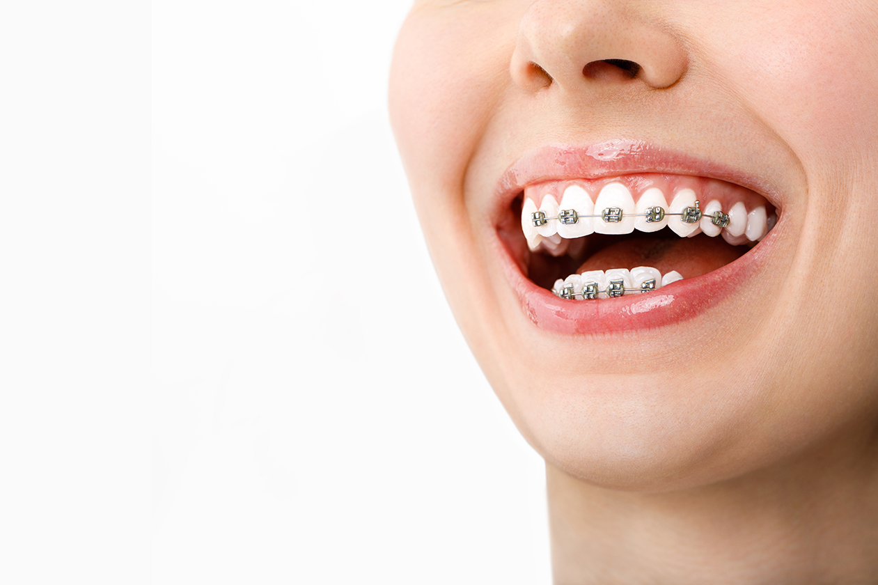 Ortodonti Tedavisi Ne Zaman Başlar